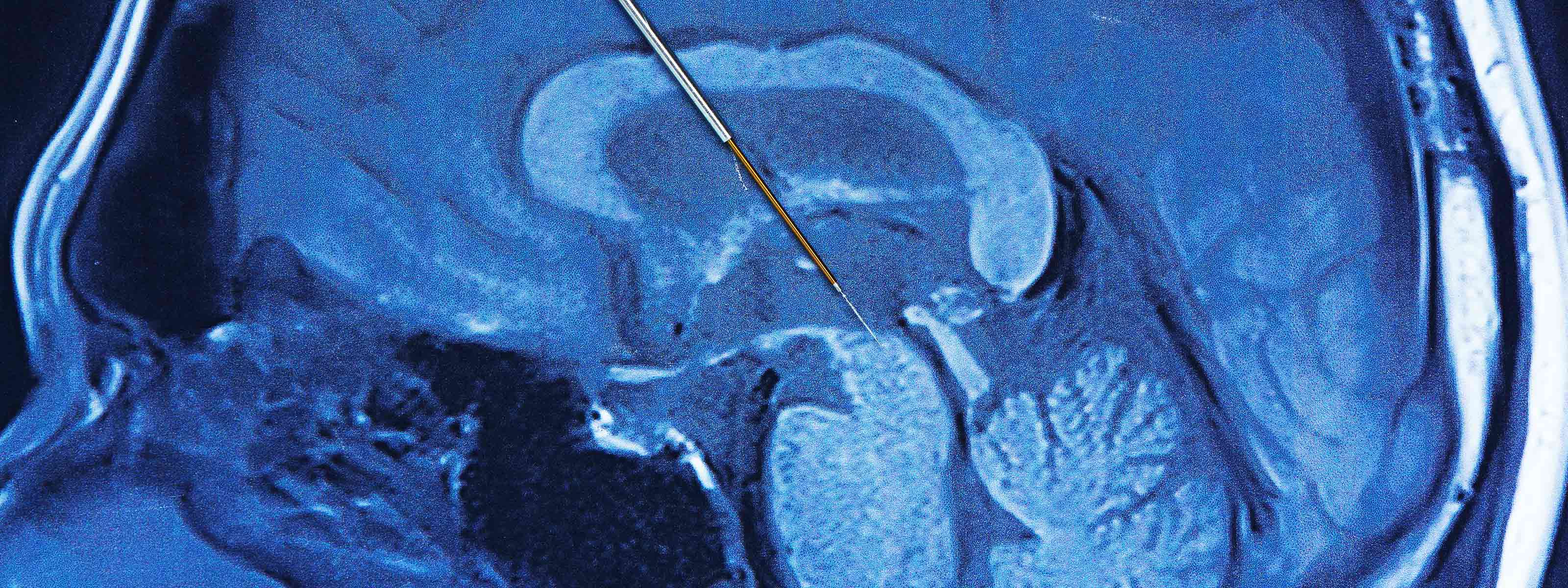 Deep Brain Stimulation: Explained