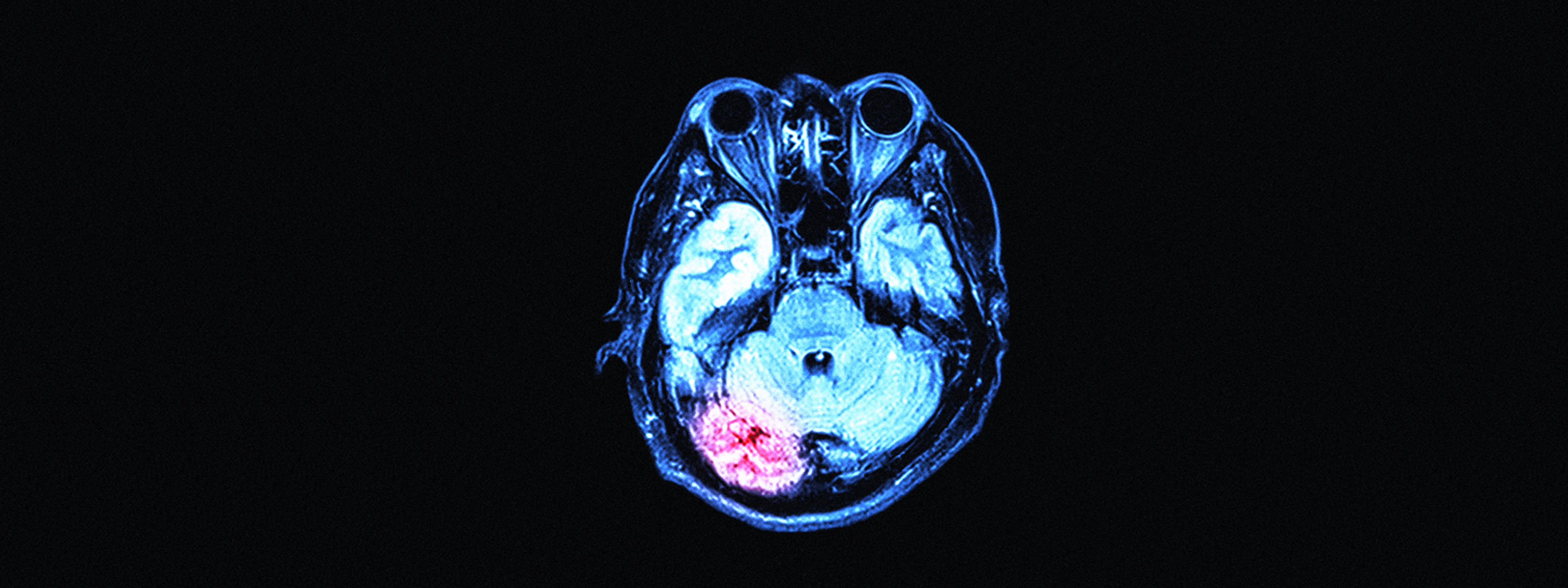 What we know about how the coronavirus affects the brain