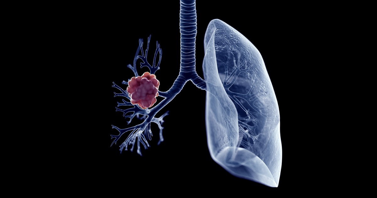 Johns Hopkins Has Developed A Lung Cancer Blood Test