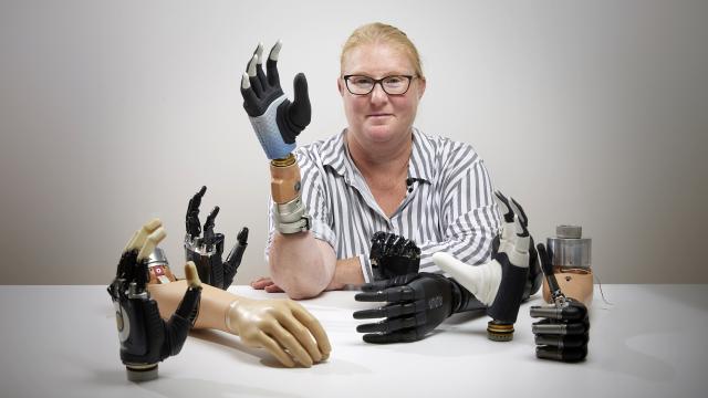 Amputee ditches prosthetic hook for bionic hand